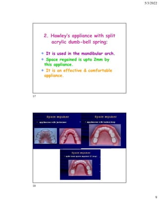 5/3/2022
9
2. Hawley’s appliance with split
acrylic dumb-bell spring:
It is used in the mandibular arch.
Space regained is upto 2mm by
this appliance.
It is an effective  comfortable
appliance.
17
18
 