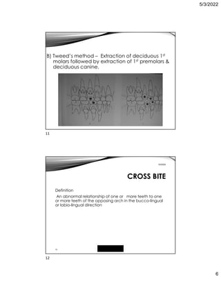 5/3/2022
6
B) Tweed’s method – Extraction of deciduous 1st
molars followed by extraction of 1st premolars 
deciduous canine.
12
5/3/2022
CROSS BITE
Definition
An abnormal relationship of one or more teeth to one
or more teeth of the opposing arch in the bucco-lingual
or labio-lingual direction
11
12
 
