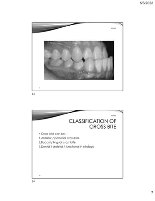 5/3/2022
7
13
5/3/2022
14
5/3/2022
CLASSIFICATION OF
CROSS BITE
• Cross bite can be :
1.Anterior / posterior cross bite
2.Buccal / lingual cross bite
3.Dental / skeletal / functional in etiology
13
14
 