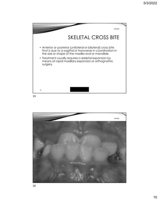 5/3/2022
10
19
5/3/2022
SKELETAL CROSS BITE
• Anterior or posterior (unilateral or bilateral) cross bite
that is due to a sagittal or transverse in coordination in
the size or shape of the maxilla and or mandible.
• Treatment usually requires a skeletal expansion by
means of rapid maxillary expansion or orthognathic
surgery.
Free template from
www.brainybetty.com
20
5/3/2022
19
20
 