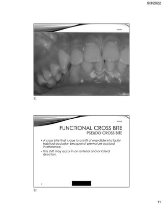 5/3/2022
11
Free template from
www.brainybetty.com
21
5/3/2022
22
5/3/2022
FUNCTIONAL CROSS BITE
PSEUDO CROSS BITE
• A cross bite that is due to a shift of mandible into faulty
habitual occlusion because of premature occlusal
interference.
• This shift may occur in an anterior and or lateral
direction.
21
22
 