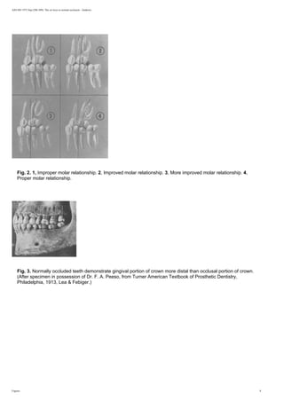 AJO-DO 1972 Sep (296-309): The six keys to normal occlusion - Andrews
Fig. 2. 1, Improper molar relationship. 2, Improved molar relationship. 3, More improved molar relationship. 4,
Proper molar relationship.
Fig. 3. Normally occluded teeth demonstrate gingival portion of crown more distal than occlusal portion of crown.
(After specimen in possession of Dr. F. A. Peeso, from Turner American Textbook of Prosthetic Dentistry,
Philadelphia, 1913, Lea  Febiger.)
Figures 8
 