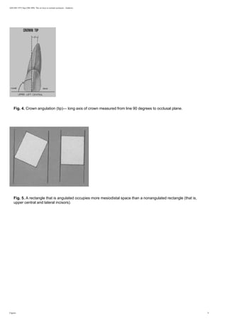 AJO-DO 1972 Sep (296-309): The six keys to normal occlusion - Andrews
Fig. 4. Crown angulation (tip)— long axis of crown measured from line 90 degrees to occlusal plane.
Fig. 5. A rectangle that is angulated occupies more mesiodistal space than a nonangulated rectangle (that is,
upper central and lateral incisors).
Figures 9
 