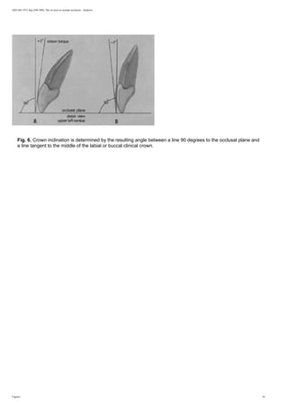 AJO-DO 1972 Sep (296-309): The six keys to normal occlusion - Andrews
Fig. 6. Crown inclination is determined by the resulting angle between a line 90 degrees to the occlusal plane and
a line tangent to the middle of the labial or buccal clinical crown.
Figures 10
 