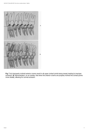 AJO-DO 1972 Sep (296-309): The six keys to normal occlusion - Andrews
Fig. 7. A, Improperly inclined anterior crowns result in all upper contact points being mesial, leading to improper
occlusion. B, Demonstration, on an overlay, that when the anterior crowns are properly inclined the contact points
move distally, allowing for normal occlusion.
Figures 11
 