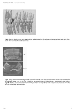 AJO-DO 1972 Sep (296-309): The six keys to normal occlusion - Andrews
Fig. 8. Spaces resulting from normally occluded posterior teeth and insufficiently inclined anterior teeth are often
falsely blamed on tooth size descrepancy.
Fig. 9. A lingual crown inclination generally occurs in normally occluded upper posterior crowns. The inclination is
constant and similar from the canines through the second premolars and slightly more pronounced in the molars.
Fig. 10. The lingual crown inclination of normally occluded lower posterior teeth progressively increases from the
canines through the second molars.
Figures 12
 