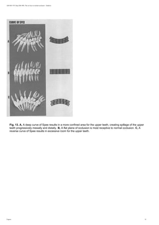 AJO-DO 1972 Sep (296-309): The six keys to normal occlusion - Andrews
Fig. 13. A, A deep curve of Spee results in a more confined area for the upper teeth, creating spillage of the upper
teeth progressively mesially and distally. B, A flat plane of occlusion is most receptive to normal occlusion. C, A
reverse curve of Spee results in excessive room for the upper teeth.
Figures 14
 