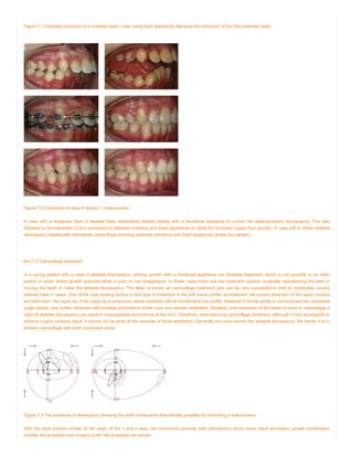 Figure 7.1 Occlusal correction of a crowded class I case using fixed appliances following the extraction of four first premolar teeth.
Figure 7.2 Correction of class II division 1 malocclusion.
A case with a moderate class II skeletal base relationship treated initially with a functional appliance to correct the anteroposterior discrepancy. This was
followed by the extraction of four premolars to alleviate crowding and fixed appliances to detail the occlusion (upper four panels). A case with a milder skeletal
discrepancy treated with orthodontic camouflage involving premolar extraction and fixed appliances (lower two panels).
Box 7.2 Camouflage treatment
In a young patient with a class II skeletal discrepancy, utilizing growth with a functional appliance can facilitate treatment, which is not possible in an older
patient or adult, where growth potential either is poor or has disappeared. In these cases there are two treatment options: surgically repositioning the jaws or
moving the teeth to mask the skeletal discrepancy. The latter is known as camouflage treatment and can be very successful in mild to moderately severe
skeletal class II cases. One of the main limiting factors in this type of treatment is the soft tissue profile, as treatment will involve retraction of the upper incisors
and with them, the upper lip. If the upper lip is protrusive, some retraction will be beneficial to the profile. However, if the lip profile is retrusive and the nasolabial
angle obtuse, any further retraction will increase prominence of the nose and worsen aesthetics. Similarly, over-retraction of the lower incisors to camouflage a
class III skeletal discrepancy can result in unacceptable prominence of the chin. Therefore, when planning camouflage treatment, although it may be possible to
achieve a good occlusal result, it should not be done at the expense of facial aesthetics. Generally the more severe the skeletal discrepancy, the harder it is to
achieve camouflage with tooth movement alone.
Figure 7.3 The envelope of discrepancy showing the tooth movements theoretically possible for correcting a malocclusion.
With the ideal position shown at the origin of the x and y axes, the movement possible with orthodontics alone (inner black envelope), growth modification
(middle red envelope) and surgery (outer red envelope) are shown.
 
