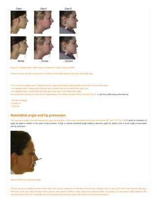 Figure 6.7 Skeletal class I (left), class II (middle) and class III (right) profiles.
Facial convexity can also be described in relation to the angle between the upper and lower face.
• In a normal or skeletal class 1 relationship, the upper jaw should be approximately 2 to 4-mm in front of the lower;
• In a skeletal class 2 relationship the lower jaw is greater than 4-mm behind the upper; and
• In a skeletal class 3 relationship the lower jaw is less than 2-mm behind the upper.
An assessment can also be made of the angle between the middle and lower third of the face (Fig. 6.7), with the profile being described as:
• Normal or straight;
• Convex; or
• Concave.
Nasolabial angle and lip protrusion
The nasolabial angle is formed between the upper lip and base of the nose (columella) and should be between 90° and 110° (Fig. 6.8). It gives an indication of
upper lip drape in relation to the upper incisor position. A high or obtuse nasolabial angle implies a retrusive upper lip, whilst a low or acute angle is associated
with lip protrusion.
Figure 6.8 Normal nasolabial angle.
The lips should be slightly everted at their base, with several millimetres of vermillion show at rest, although they do tend to become more retrusive with age.
Protrusion of the lips varies between ethnic groups, with patients of African origin being more protrusive than Caucasians. Lip protrusion is also relative to the
size and shape of the chin. Generally, lips are considered too protrusive when both are prominent and incompetent.
 