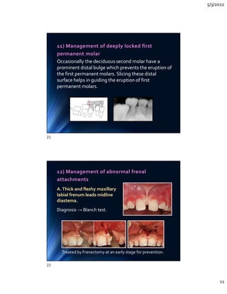 5/3/2022
11
11) Management of deeply locked first
permanent molar
Occasionally the deciduous second molar have a
prominent distal bulge which prevents the eruption of
the first permanent molars. Slicing these distal
surface helps in guiding the eruption of first
permanent molars.
Occasionally the deciduous second molar have a
prominent distal bulge which prevents the eruption of
the first permanent molars. Slicing these distal
surface helps in guiding the eruption of first
permanent molars.
12) Management of abnormal frenal
attachments
A.Thick and fleshy maxillary
labial frenum leads midline
diastema.
Diagnosis → Blanch test.
A.Thick and fleshy maxillary
labial frenum leads midline
diastema.
Diagnosis → Blanch test.
Treated by Frenectomy at an early stage for prevention.
21
22
 