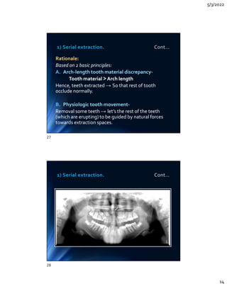 5/3/2022
14
1) Serial extraction. Cont…
Rationale:
Based on 2 basic principles:
A. Arch-length tooth material discrepancy-
Tooth material  Arch length
Hence, teeth extracted → So that rest of tooth
occlude normally.
B. Physiologic tooth movement-
Removal some teeth → let’s the rest of the teeth
(which are erupting) to be guided by natural forces
towards extraction spaces.
Rationale:
Based on 2 basic principles:
A. Arch-length tooth material discrepancy-
Tooth material  Arch length
Hence, teeth extracted → So that rest of tooth
occlude normally.
B. Physiologic tooth movement-
Removal some teeth → let’s the rest of the teeth
(which are erupting) to be guided by natural forces
towards extraction spaces.
1) Serial extraction. Cont…
27
28
 