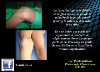 Luxación de Rótula