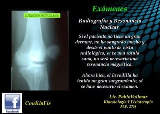 Luxación de Rótula