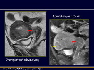 Αζπλήζηζηε απεηθόληζε
Άηππε εζηηαθή αδελνκύσζε
Βασ. Δ. Σουφτάς: Εμβολισμός Ινομυωμάτων Μήτρας
 