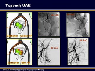 40o LAO 40o RAO
40o LAO
40o RAO
Τεχνική UAE
Βασ. Δ. Σουφτάς: Εμβολισμός Ινομυωμάτων Μήτρας
 