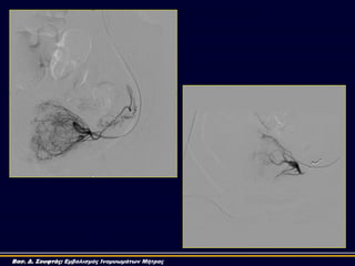 Βασ. Δ. Σουφτάς: Εμβολισμός Ινομυωμάτων Μήτρας
 
