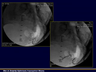 Βασ. Δ. Σουφτάς: Εμβολισμός Ινομυωμάτων Μήτρας
 