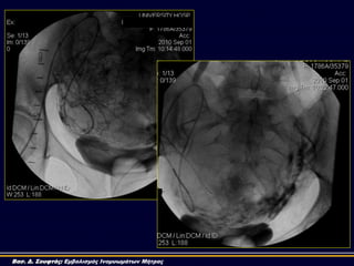 Βασ. Δ. Σουφτάς: Εμβολισμός Ινομυωμάτων Μήτρας
 