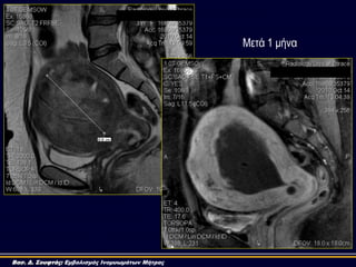 Μεηά 1 κήλα
Βασ. Δ. Σουφτάς: Εμβολισμός Ινομυωμάτων Μήτρας
 