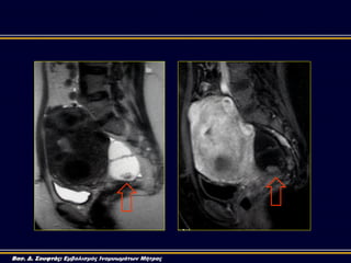 Βασ. Δ. Σουφτάς: Εμβολισμός Ινομυωμάτων Μήτρας
 