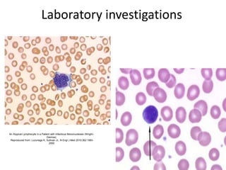 Laboratory investigations
An Atypical Lymphocyte in a Patient with Infectious Mononucleosis (Wright–
Giemsa).
Reproduced from: Luzuriaga K, Sullivan JL. N Engl J Med 2010;362:1993-
2000
 