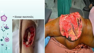 • tissue necrosis;
 