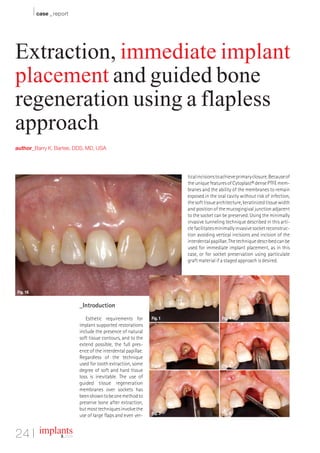 I case _ report


Extraction, immediate implant
placement and guided bone
regeneration using a flapless
approach
author_Barry K. Bartee, DDS, MD, USA




                                                                            tical incisions to achieve primary closure. Because of
                                                                            the unique features of Cytoplast® dense PTFE mem-
                                                                            branes and the ability of the membranes to remain
                                                                            exposed in the oral cavity without risk of infection,
                                                                            the soft tissue architecture, keratinized tissue width
                                                                            and position of the mucogingival junction adjacent
                                                                            to the socket can be preserved. Using the minimally
                                                                            invasive tunneling technique described in this arti-
                                                                            cle facilitates minimally invasive socket reconstruc-
                                                                            tion avoiding vertical incisions and incision of the
                                                                            interdental papillae. The technique described can be
                                                                            used for immediate implant placement, as in this
                                                                            case, or for socket preservation using particulate
                                                                            graft material if a staged approach is desired.




Fig. 16


                               _Introduction
                                  Esthetic requirements for        Fig. 1                     Fig. 4
                               implant supported restorations
                               include the presence of natural
                               soft tissue contours, and to the
                               extend possible, the full pres-
                               ence of the interdental papillae.
                               Regardless of the technique
                               used for tooth extraction, some     Fig. 2                     Fig. 5
                               degree of soft and hard tissue
                               loss is inevitable. The use of
                               guided tissue regeneration
                               membranes over sockets has
                               been shown to be one method to
                               preserve bone after extraction,
                               but most techniques involve the
                                                                   Fig. 3                     Fig. 6
                               use of large flaps and even ver-


24 I implants        3_ 2009
 