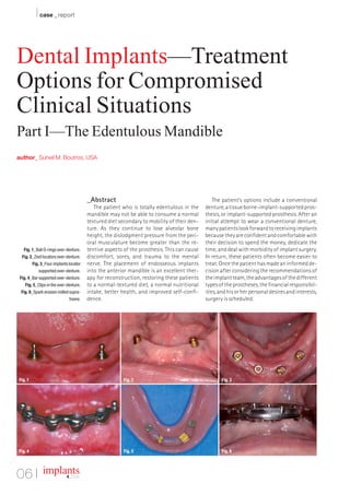 I case _ report


Dental Implants—Treatment
Options for Compromised
Clinical Situations
Part I—The Edentulous Mandible
author_ Suheil M. Boutros, USA




                                        _Abstract                                               The patient’s options include a conventional
                                           The patient who is totally edentulous in the     denture, a tissue borne-implant-supported pros-
                                        mandible may not be able to consume a normal        thesis, or implant-supported prosthesis. After an
                                        textured diet secondary to mobility of their den-   initial attempt to wear a conventional denture,
                                        ture. As they continue to lose alveolar bone        many patients look forward to receiving implants
                                        height, the dislodgment pressure from the peri-     because they are confident and comfortable with
                                        oral musculature become greater than the re-        their decision to spend the money, dedicate the
   Fig. 1_Ball O-rings over-denture.    tentive aspects of the prosthesis. This can cause   time, and deal with morbidity of implant surgery.
  Fig. 2_Zest locators over-denture.    discomfort, sores, and trauma to the mental         In return, these patients often become easier to
         Fig. 3_Four implants locator   nerve. The placement of endosseous implants         treat. Once the patient has made an informed de-
             supported over-denture.    into the anterior mandible is an excellent ther-    cision after considering the recommendations of
 Fig. 4_Bar supported over-denture.     apy for reconstruction, restoring these patients    the implant team, the advantages of the different
    Fig. 5_Clips in the over-denture.   to a normal-textured diet, a normal nutritional     types of the prostheses, the financial responsibil-
  Fig. 6_Spark erosion milled supra-    intake, better health, and improved self-confi-     ities, and his or her personal desires and interests,
                               frame.   dence.                                              surgery is scheduled.




Fig. 1                                                  Fig. 2                                     Fig. 3




Fig. 4                                                  Fig. 5                                     Fig. 6




06 I implants               4_ 2009
 