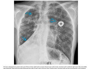 PA chest radiograph of a patient with cystic fibrosis shows right basilar airspace disease (cyan solid arrow), consistent with combined right lower lobe and middle
lobe atelectasis. Note bronchial wall thickening (cyan open arrow), cystic lucencies (cyan curved arrow), consistent with saccular bronchiectasis, and multifocal
 