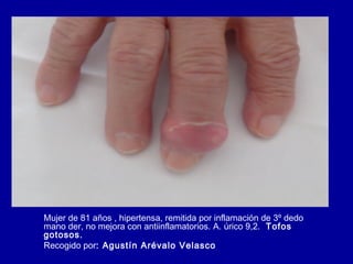 Mujer de 81 años , hipertensa, remitida por inflamación de 3º dedo
mano der, no mejora con antiinflamatorios. A. úrico 9,2. Tofos
gotosos.
Recogido por: Agustín Arévalo Velasco
 