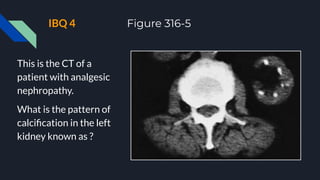IBQ 4 Figure 316-5
This is the CT of a
patient with analgesic
nephropathy.
What is the pattern of
calciﬁcation in the left
kidney known as ?
 