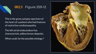 IBQ 5 Figure 259-12
This is the gross autopsy specimen of
the heart of a patient who had features
of restrictive cardiomyopathy.
The left atrial endocardium has
characteristic yellow brown deposits.
What could be the possible etiology ?
 