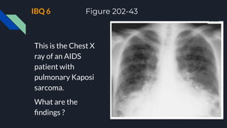 IBQ 6 Figure 202-43
This is the Chest X
ray of an AIDS
patient with
pulmonary Kaposi
sarcoma.
What are the
ﬁndings ?
 