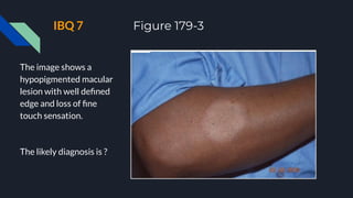 IBQ 7 Figure 179-3
The image shows a
hypopigmented macular
lesion with well deﬁned
edge and loss of ﬁne
touch sensation.
The likely diagnosis is ?
 