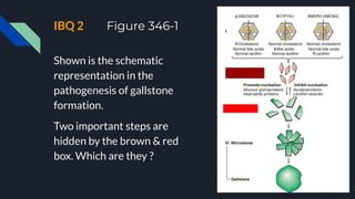 IBQ 2 Figure 346-1
Shown is the schematic
representation in the
pathogenesis of gallstone
formation.
Two important steps are
hidden by the brown & red
box. Which are they ?
 