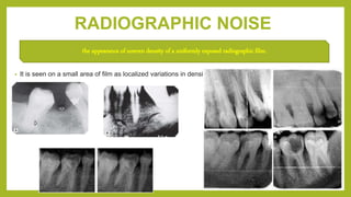 RADIOGRAPHIC NOISE
• It is seen on a small area of film as localized variations in density.
the appearance of uneven density of a uniformly exposed radiographic film.
 