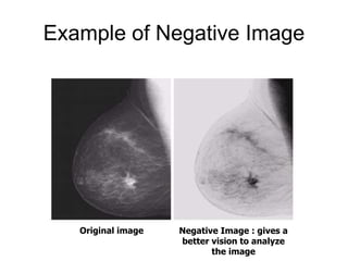 Example of Negative Image
Original image Negative Image : gives a
better vision to analyze
the image
 