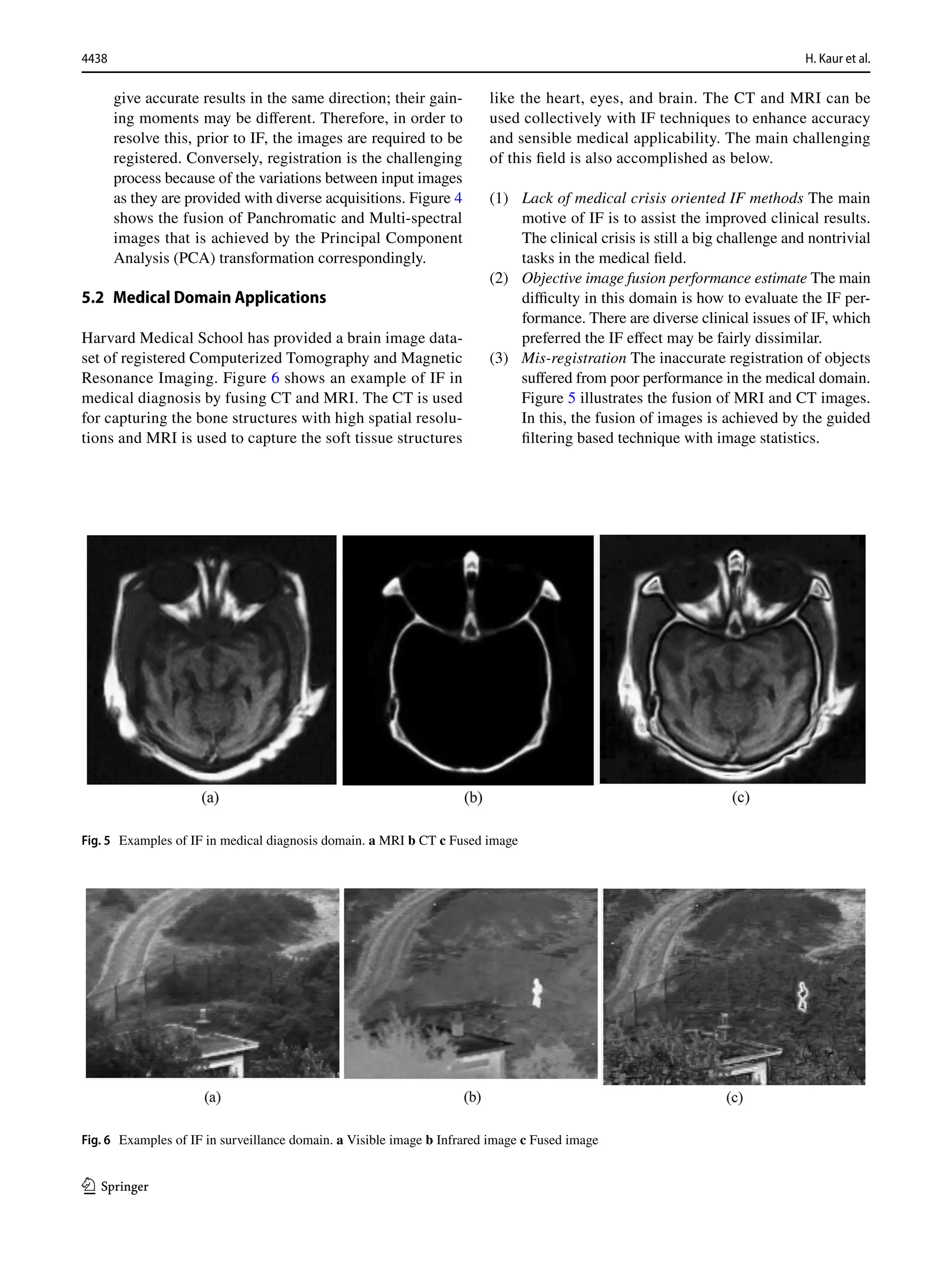 4438 H. Kaur et al.
1 3
give accurate results in the same direction; their gain-
ing moments may be different. Therefore, in order to
resolve this, prior to IF, the images are required to be
registered. Conversely, registration is the challenging
process because of the variations between input images
as they are provided with diverse acquisitions. Figure 4
shows the fusion of Panchromatic and Multi-spectral
images that is achieved by the Principal Component
Analysis (PCA) transformation correspondingly.
5.2 Medical Domain Applications
Harvard Medical School has provided a brain image data-
set of registered Computerized Tomography and Magnetic
Resonance Imaging. Figure 6 shows an example of IF in
medical diagnosis by fusing CT and MRI. The CT is used
for capturing the bone structures with high spatial resolu-
tions and MRI is used to capture the soft tissue structures
like the heart, eyes, and brain. The CT and MRI can be
used collectively with IF techniques to enhance accuracy
and sensible medical applicability. The main challenging
of this field is also accomplished as below.
(1) Lack of medical crisis oriented IF methods The main
motive of IF is to assist the improved clinical results.
The clinical crisis is still a big challenge and nontrivial
tasks in the medical field.
(2) Objective image fusion performance estimate The main
difficulty in this domain is how to evaluate the IF per-
formance. There are diverse clinical issues of IF, which
preferred the IF effect may be fairly dissimilar.
(3) Mis-registration The inaccurate registration of objects
suffered from poor performance in the medical domain.
Figure 5 illustrates the fusion of MRI and CT images.
In this, the fusion of images is achieved by the guided
filtering based technique with image statistics.
Fig. 5  Examples of IF in medical diagnosis domain. a MRI b CT c Fused image
Fig. 6  Examples of IF in surveillance domain. a Visible image b Infrared image c Fused image
 