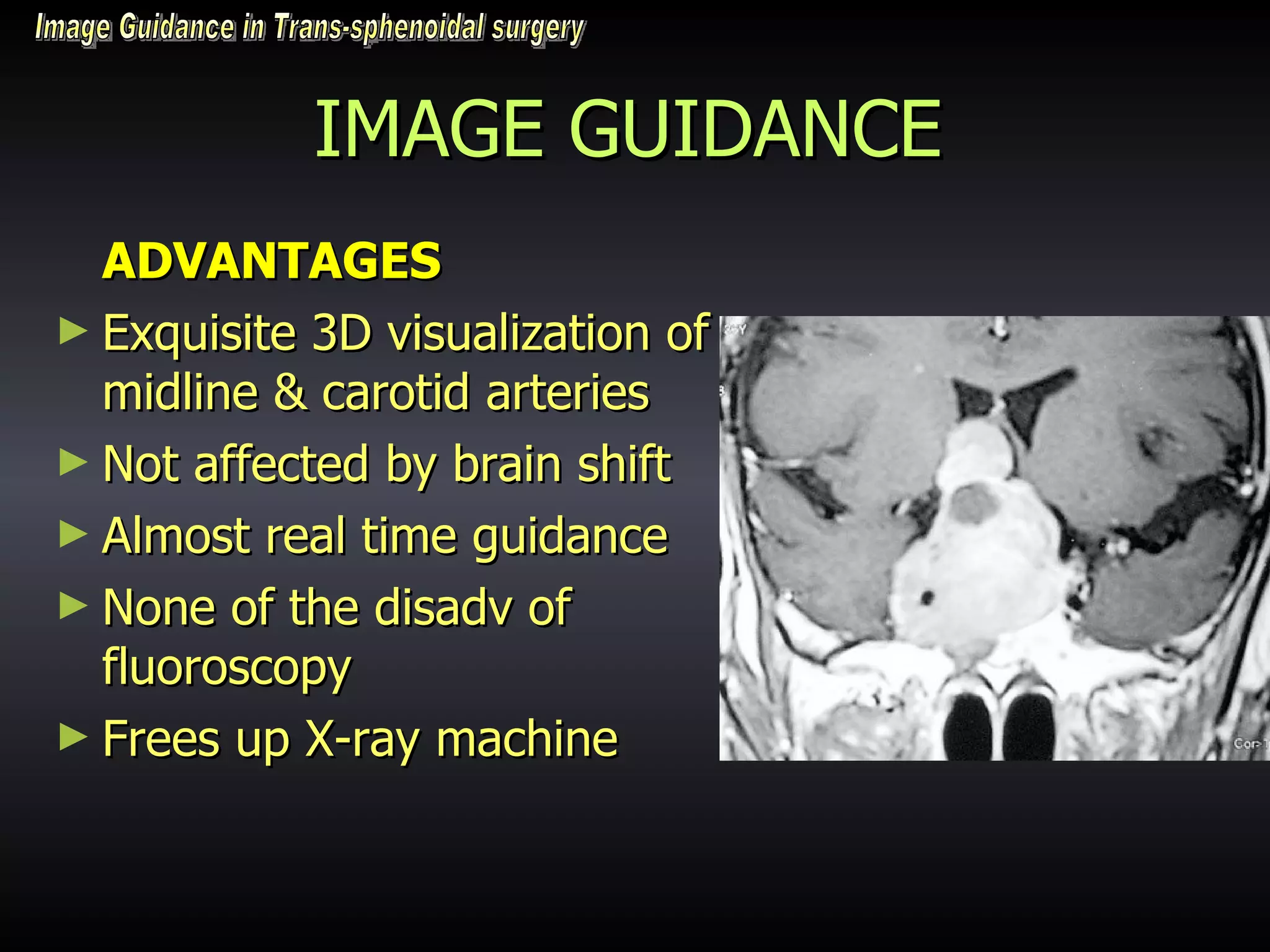 IMAGE GUIDANCE ADVANTAGES Exquisite 3D visualization of midline & carotid arteries Not affected by brain shift Almost real time guidance None of the disadv of fluoroscopy Frees up X-ray machine Image Guidance in Trans-sphenoidal surgery 