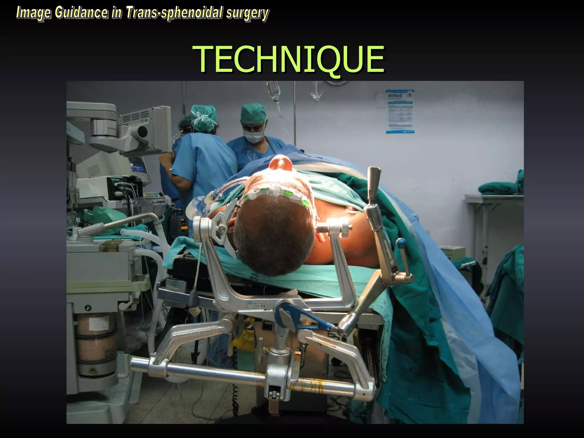 TECHNIQUE Image Guidance in Trans-sphenoidal surgery 