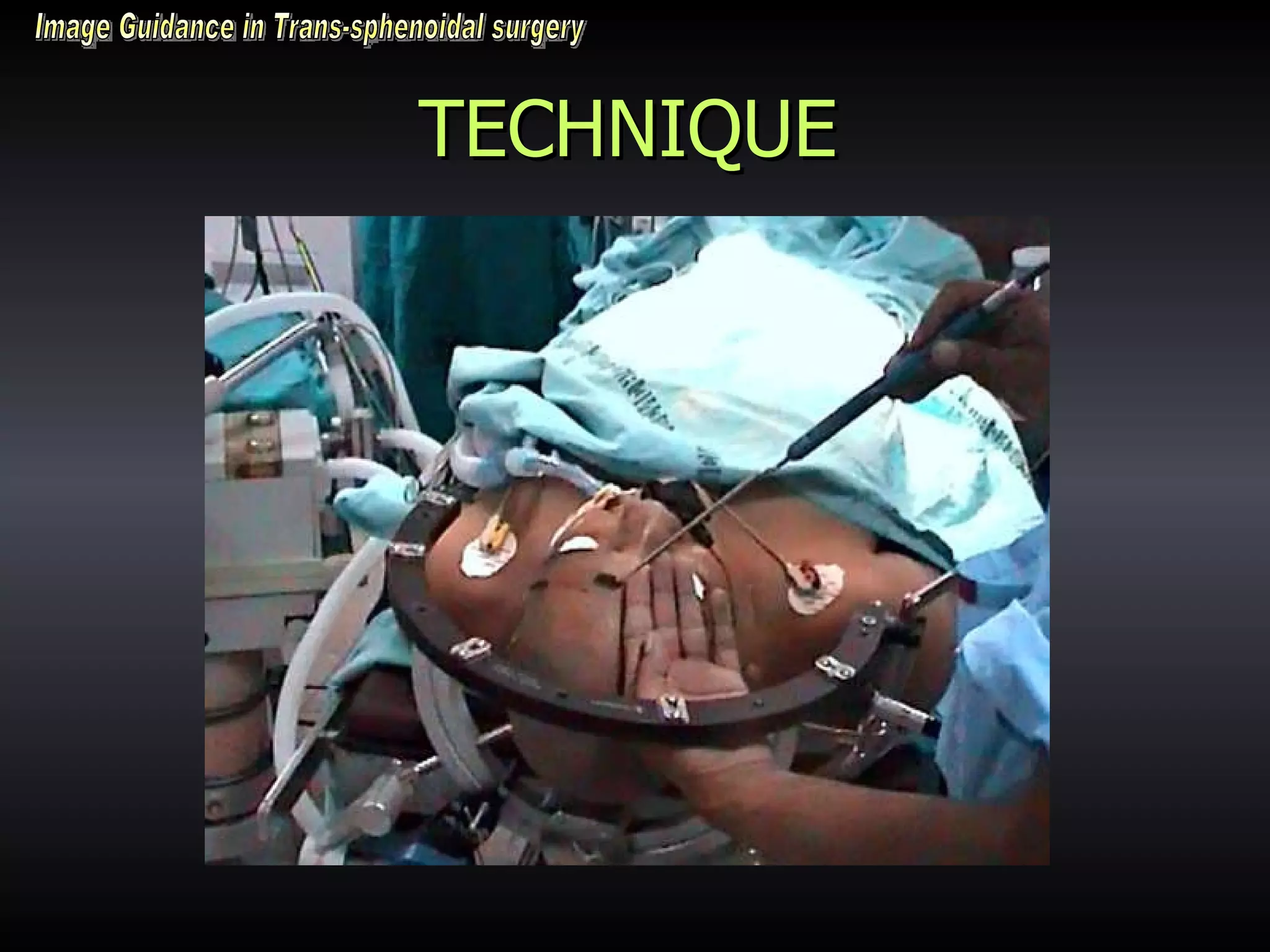 TECHNIQUE Image Guidance in Trans-sphenoidal surgery 