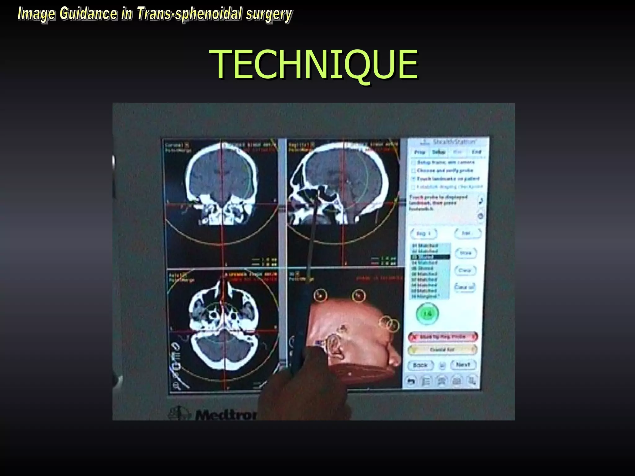 TECHNIQUE Image Guidance in Trans-sphenoidal surgery 