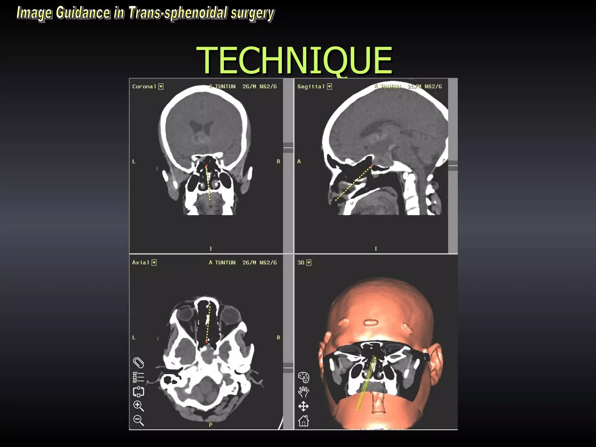 TECHNIQUE Image Guidance in Trans-sphenoidal surgery 