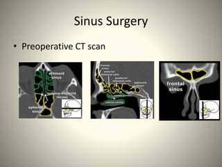 Close Ct Scan Image Guided ESS | PPTX