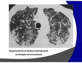Espessamento de Septos Interlobulares
(Linfangite Carcinomatosa)
 