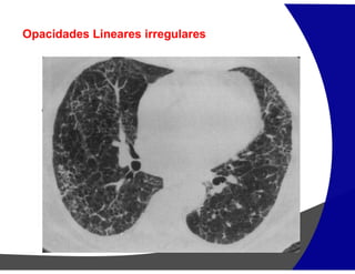 Opacidades Lineares irregulares
 