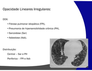 Opacidade Lineares Irregulares:
DDX:
• Fibrose pulmonar idiopática (FPI),
• Pneumonia de hipersensibilidade crônica (PH),
• Sarcoidose (Sar)
• Asbestose (Asb).
Distribuição:
Central – Sar e PH
Periferica – FPI e Asb
 