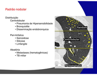 Padrão nodular
Distribuição
Centrolobular
• Pneumonia de Hipersensibilidade
• Bronquiolite
• Disseminação endobronquica
Peri-linfatica
• Sarcoidose
• Silicose
• Linfangite
Aleatória
• Metastases (hematogênicas)
• TB miliar
 