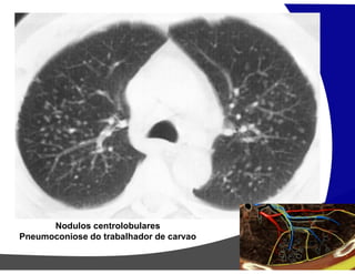 Nodulos centrolobulares
Pneumoconiose do trabalhador de carvao
 