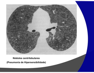 Nódulos centrilobulares
(Pneumonia de Hipersensibilidade)
 